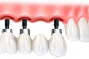 Имплантат верхнего  зуба