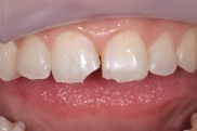 Восстановление переднего зуба