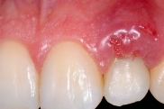 Осложнения при имплантации зубов