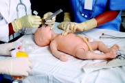 Интубация трахеи у новорожденных
