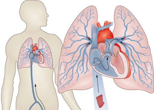 Показания к хирургическому лечению легочной артерии2