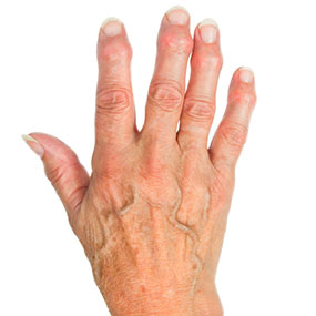 Артрит суставов пальцев рук