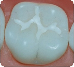 Эндодонтическое лечение зубов у детей12