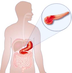Патологии кишечника и поджелудочной железы thumbnail