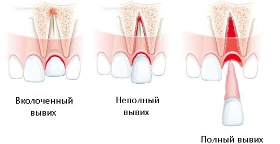 Полный вывих зубов у детей лечение thumbnail