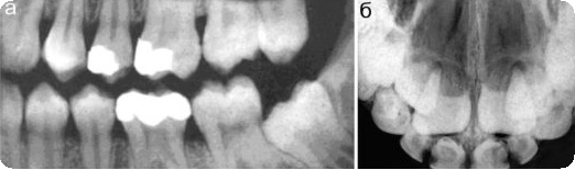Особенности эндодонтического лечения зубов у детей thumbnail