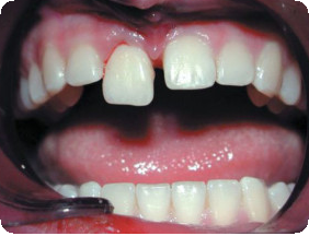 Вывих зуба: полный и неполный. Вывихи молочных зубов у детей4