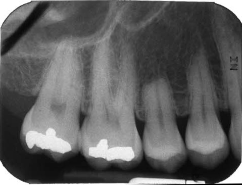 Вывих молочного зуба лечение thumbnail