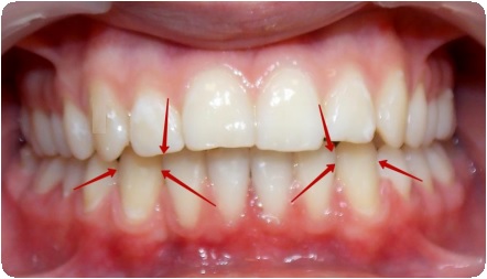 Вывих зуба: полный и неполный. Вывихи молочных зубов у детей6