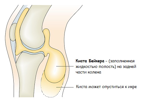 Киста бейкера коленного сустава симптомы