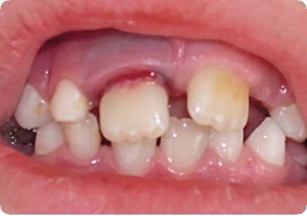 Вывих зуба: полный и неполный. Вывихи молочных зубов у детей8