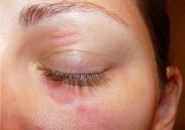 Аллергия вокруг глаз 2