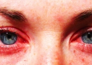 Аллергия вокруг глаза у ребенка
