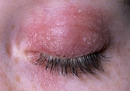 Аллергия вокруг глаз фото