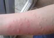 Холодовая аллергия на руках у детей фото thumbnail