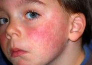 аллергия на холод у ребенка