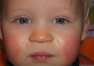аллергия на холод ребенок